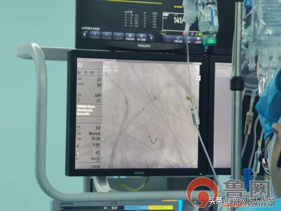 临沂人民医院首例人工心脏,临沂市人民医院做心脏射频消融术