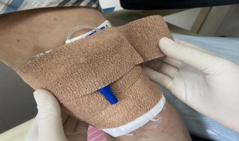 picc置管敷贴皮肤痒如何处理,picc置管防过敏贴膜进口