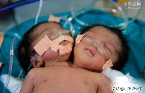 巴西双头婴儿,巴西双头婴儿后续
