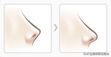 鼻翼缩小和鼻翼缩小之后的对比,超有效的缩小鼻翼的方法