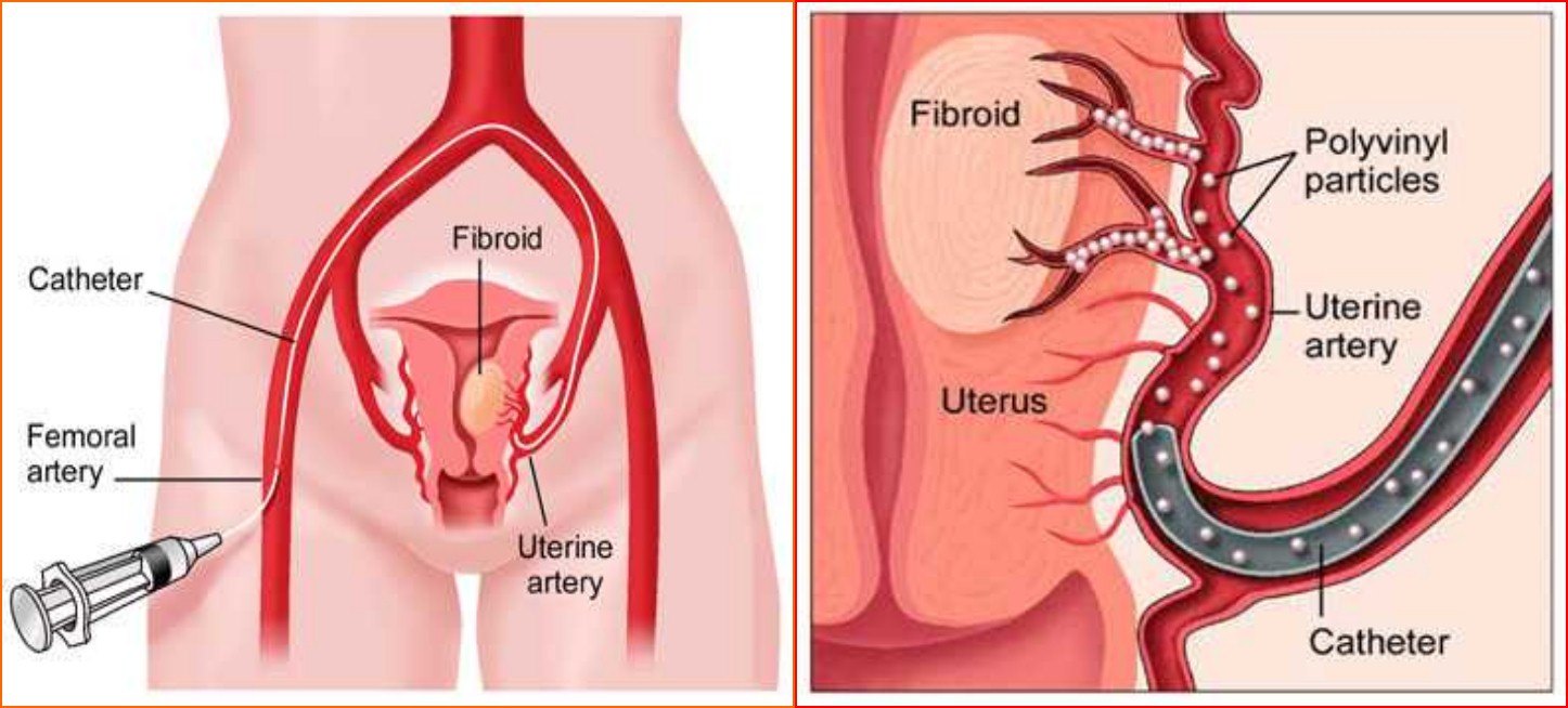 「不死的癌症」之克星——子宫腺肌症介入栓塞治疗