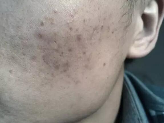 这才是祛痘印最正确的打开方式,全球公认最有效的祛痘印方法