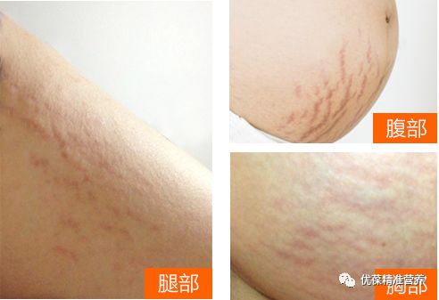 屁股妊娠纹怎么避免,男生妊娠纹如何避免