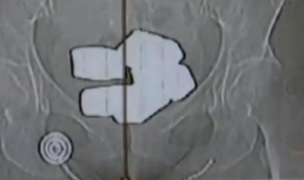 女子身戴24斤黄金被海关查获,女子把两斤黄金藏体内