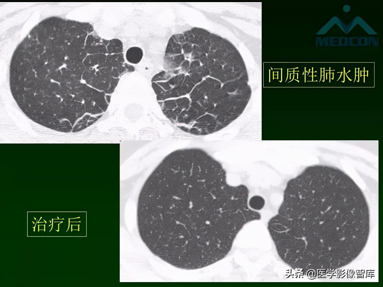 肺弥漫性网状影,两肺小叶间隔增厚可见网状模糊影
