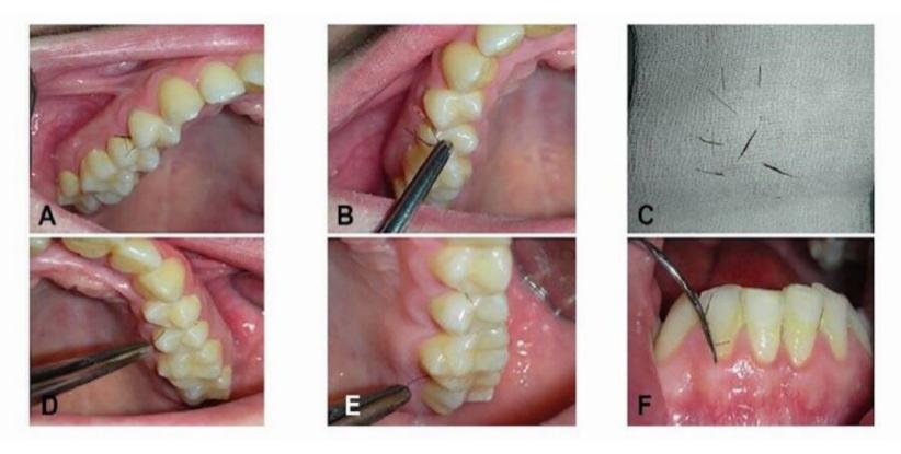一女子患上罕见牙龈多毛症，牙齿里竟然长出了毛发
