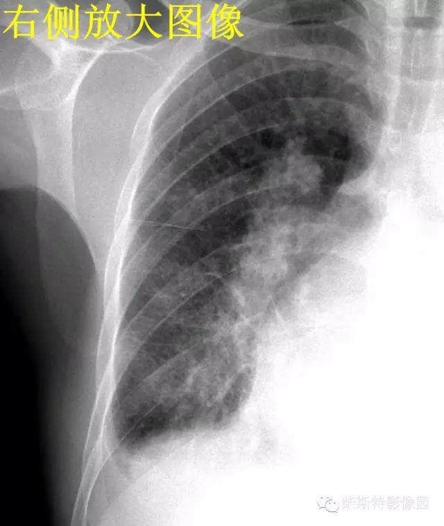 影像经典之KerleyA线、KerleyB线、KerleyC线