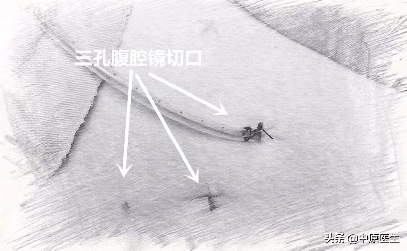 一个切口的阑尾炎手术,阑尾炎微创肚脐部位有个洞