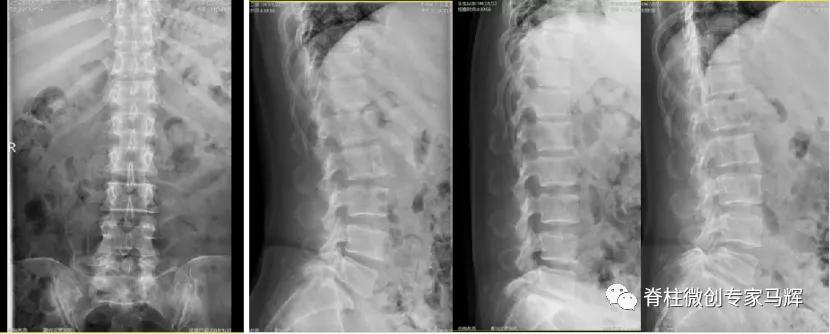 腰椎脓肿会发烧吗,腰间盘突出引起下肢疼痛发烧