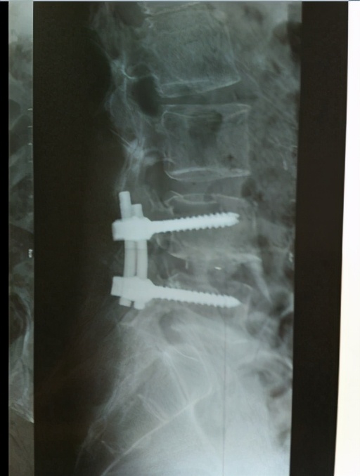 一招解决椎间盘疼痛,椎间盘膨出腰腿疼怎么办