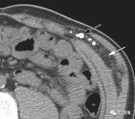 腹壁病变诊断思路,腹部影像诊断读片入门视频