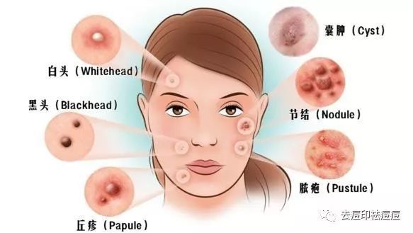 教你如何去除闭合性粉刺，分分钟学会！