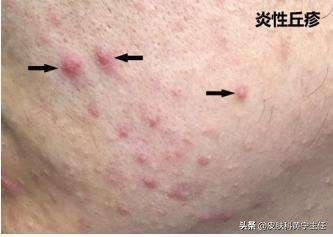 宅家的1个多月都没化妆,竟然还爆痘