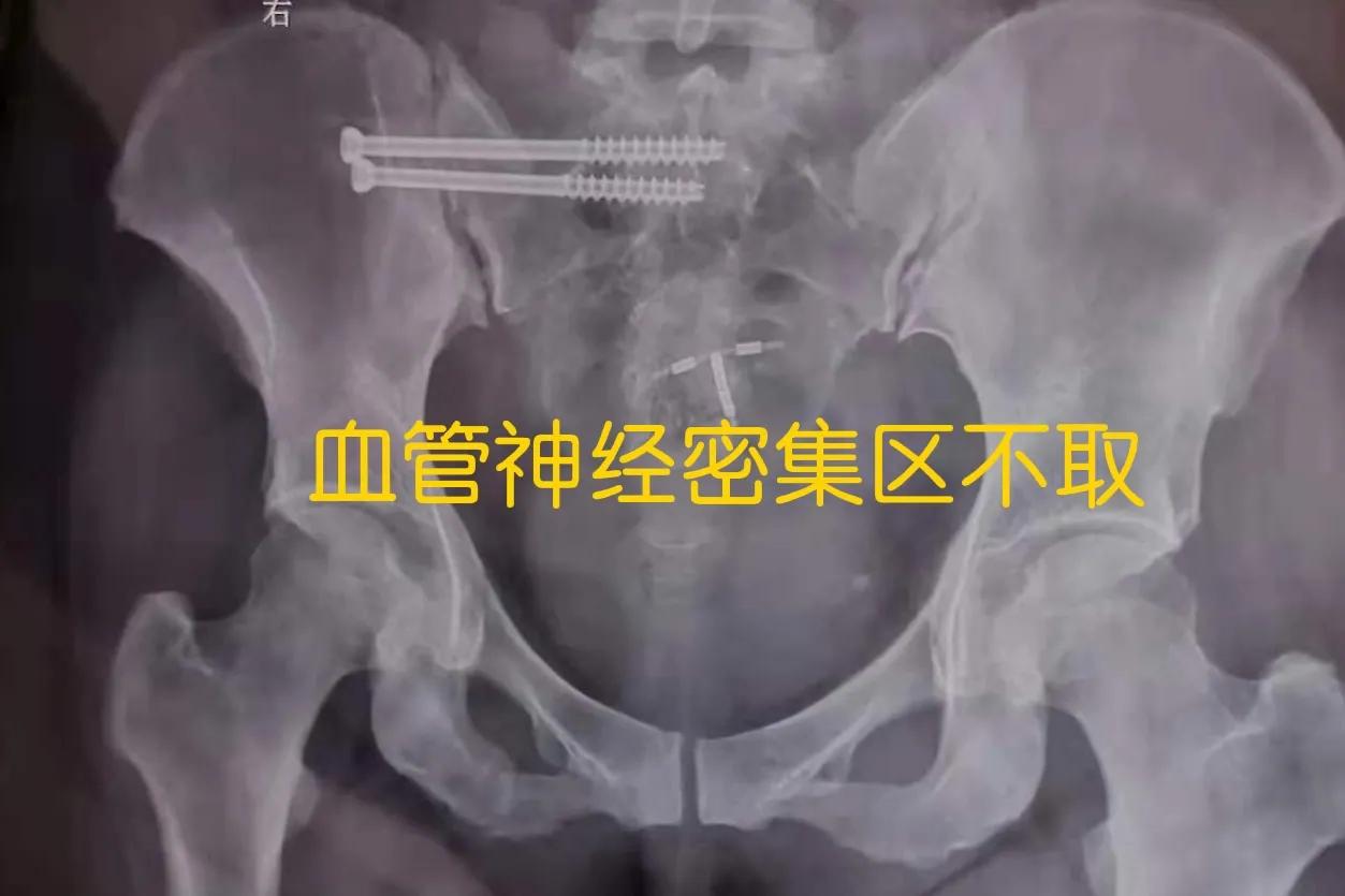 股骨粗隆骨折术后钢板取还是不取,锁骨骨折术后三个月可以取钢板吗