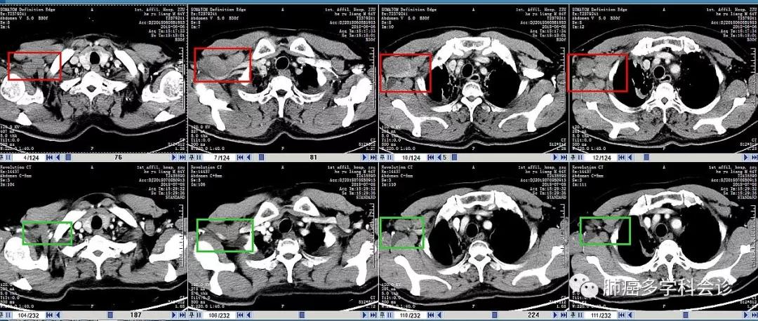 aacr肺癌高发,小细胞肺癌abc临床试验