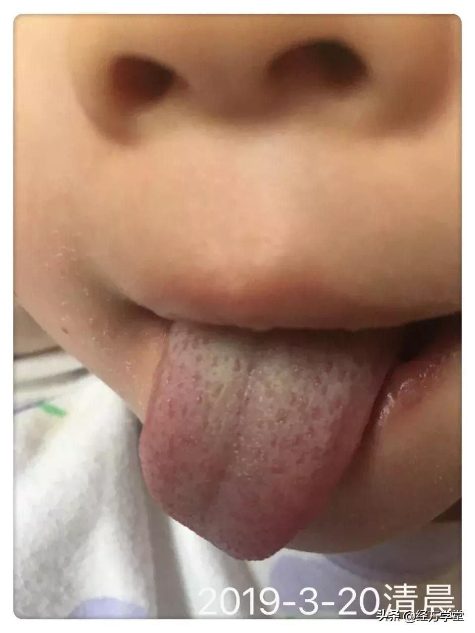 小柴胡汤加升降散医案,小柴胡颗粒治感冒后期咳嗽