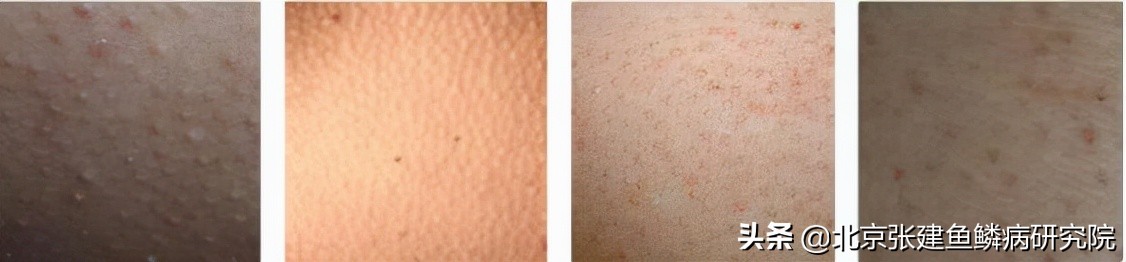 如何辨别毛周角化和毛囊炎,如何辨别毛囊是否已经坏死