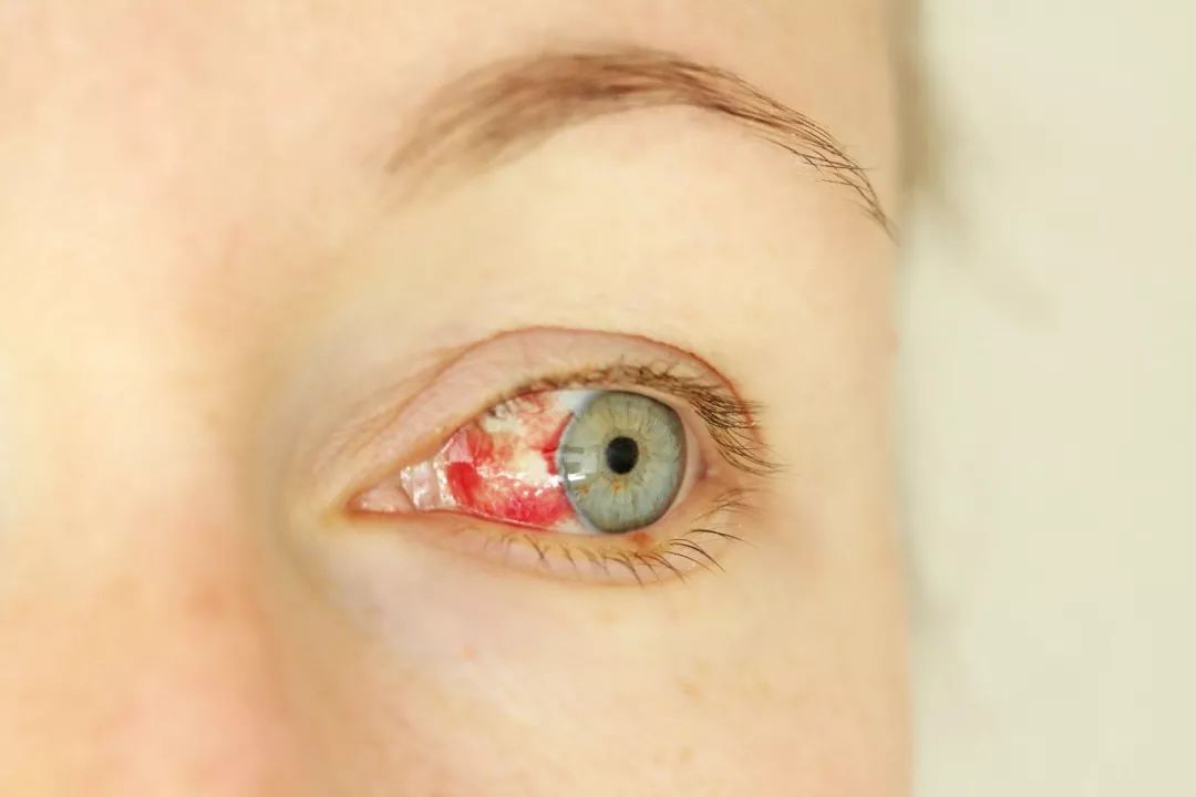 突然发现眼睛红是什么原因,眼睛红血丝可怕