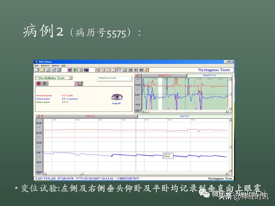 良性位置性眩晕诊断和治疗指南,良性阵发性位置性眩晕的诊断标准