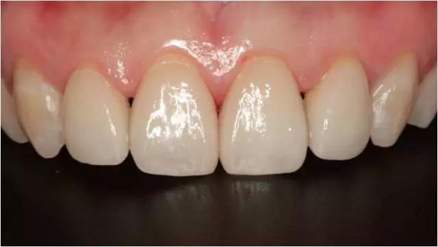 两门牙中间的缝隙越来越大,为什么门牙缝隙大这么难看