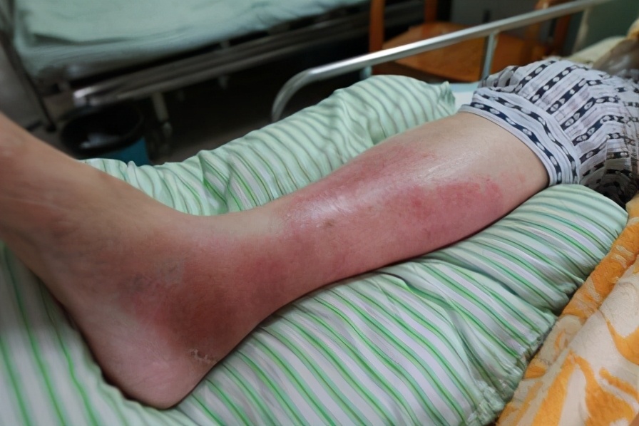 痛风的基础知识及用药,痛风各期用药攻略