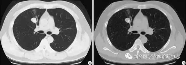 肺部有球形病灶怎么治疗,肺内多发结节诊断早期肺癌怎么办