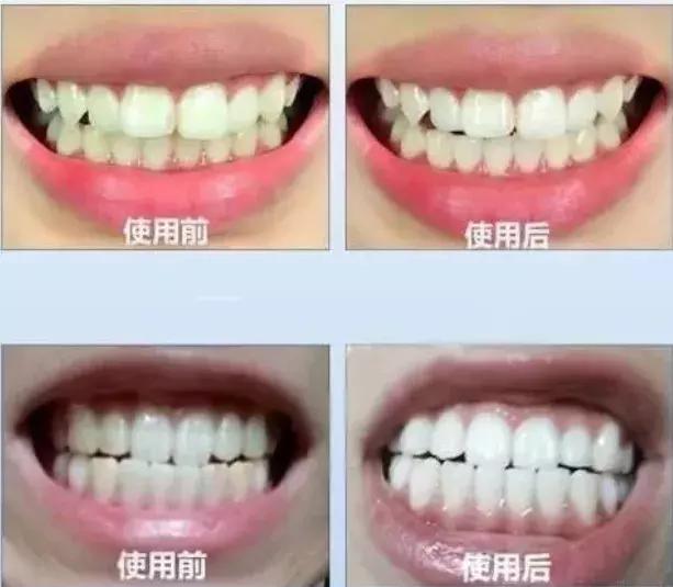 美牙仪白牙神器,网红爆款美牙仪新科技