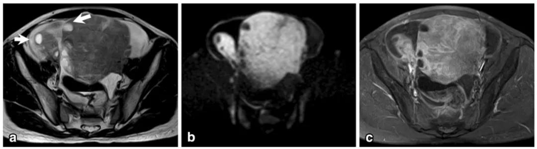 卵巢实性为主肿瘤，这13种你都想到了吗？