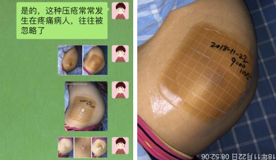 压疮敷料的选择及使用,褥疮敷料的正确使用方法