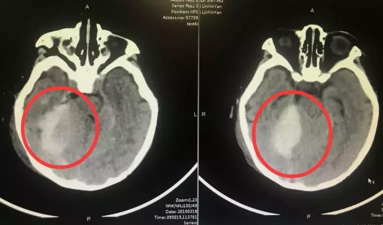 小孩颅脑损伤患者应如何处理,颅脑疾病的预防