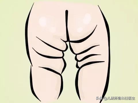 孩子臀纹不对称，看完门诊还是不明白？一次性解答你所有问题