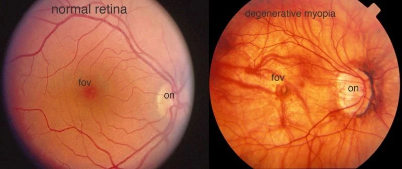 低度近视需要担心吗,低度近视需要戴防控眼镜吗