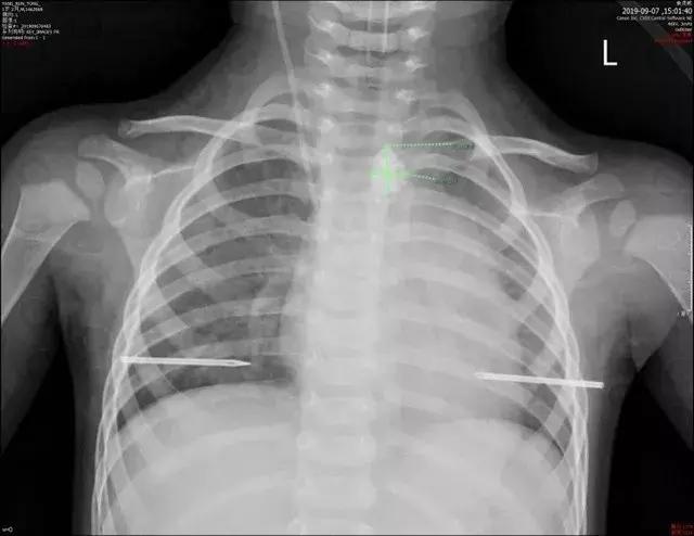 小孩误吃碎玻璃最坏后果,儿童误吞玻璃死亡