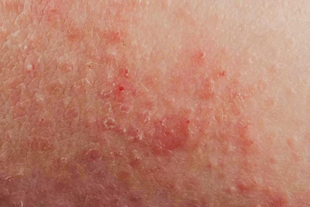 一坨痒痒的小疙瘩,咯吱窝一片一片的红疙瘩很痒