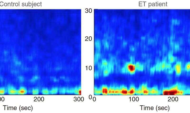 脑电波肢体不自主抖动原因,脑电波突然上下波动正常吗