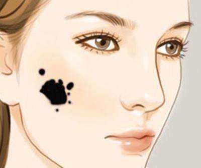 黑毛痣不治疗会怎么样,北京八大处整形医院治疗黑毛痣