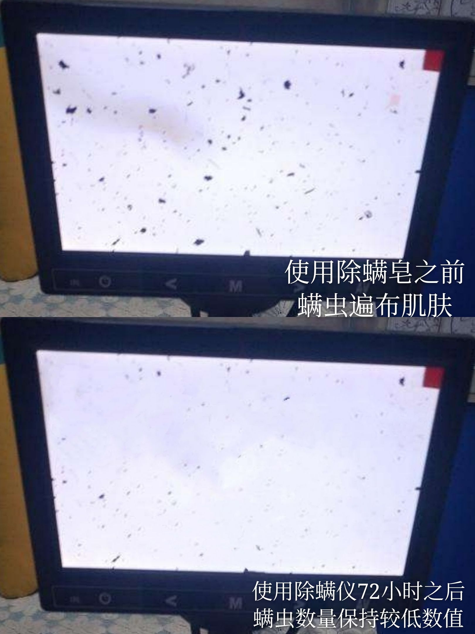 身上的螨虫会粘在衣服上吗,身上螨虫太多身体会烂么