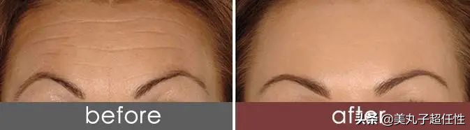 一招解决抬头纹的方法,抬头纹真正解决办法