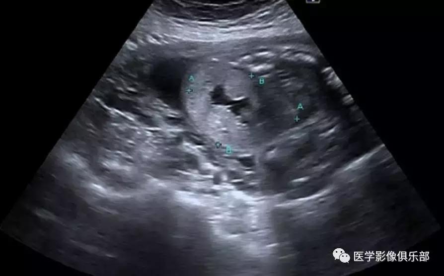 双肾多发小囊肿到底是不是多囊肾,肾多发囊肿与多囊肾的超声鉴别