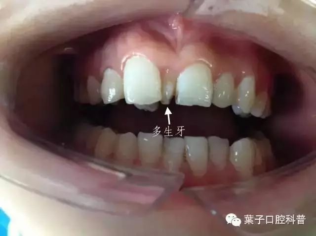 4岁小孩儿牙缝大正常吗,小朋友牙缝大正常吗
