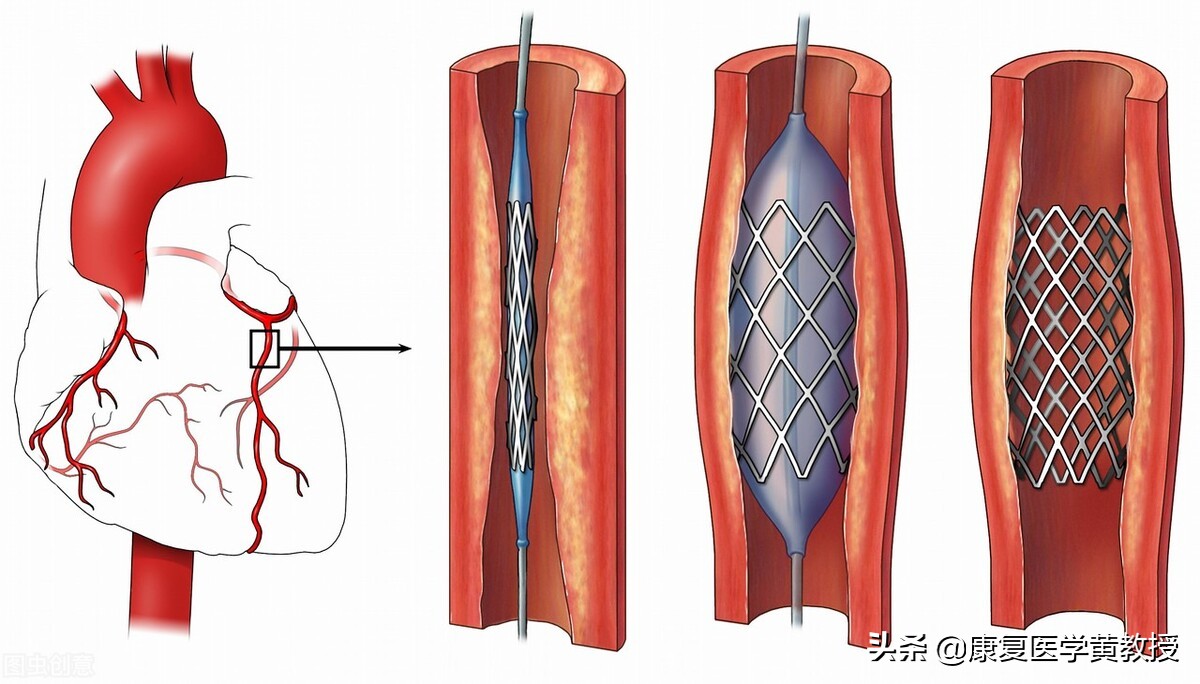 康復治疗效果不佳，可能是大脑经历了习得性无助的认知崩溃状态？