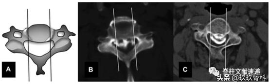 acaf手术适应脊髓型颈椎病吗,acaf术后康复方法