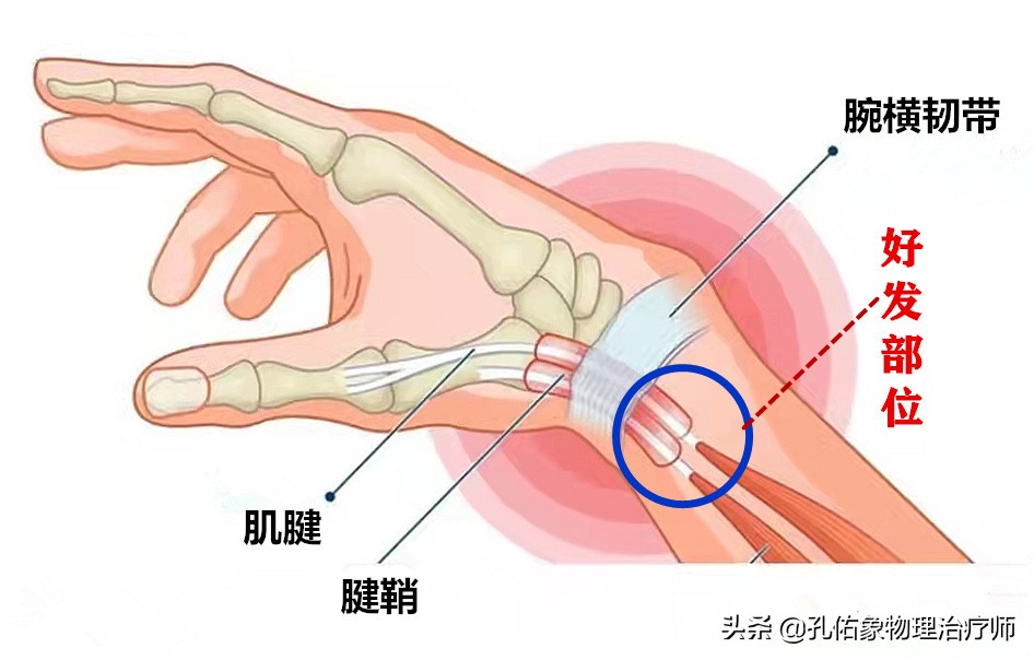 中年妇女手指疼痛僵硬是什么原因,老人手指腱鞘炎如何治疗
