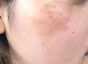 氨甲环酸对褐青斑有效果吗 (氨甲环酸去褐青斑吗)