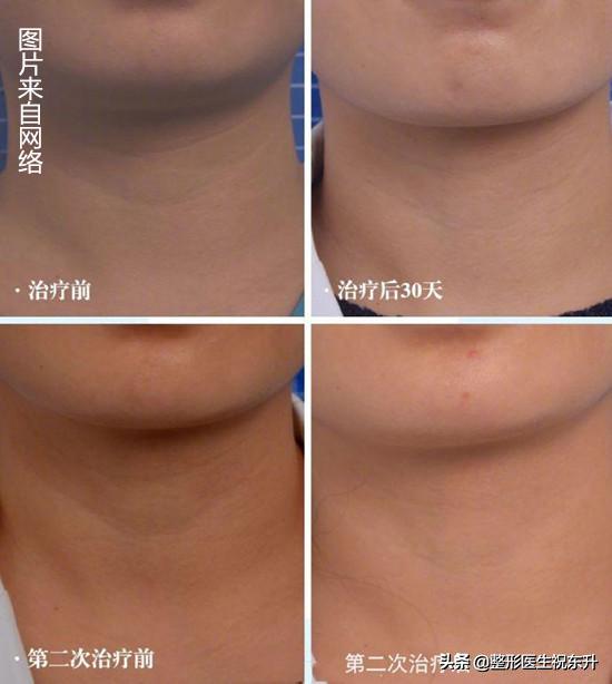 小女孩颈纹是怎么形成的,脖子上的颈纹是怎么形成的