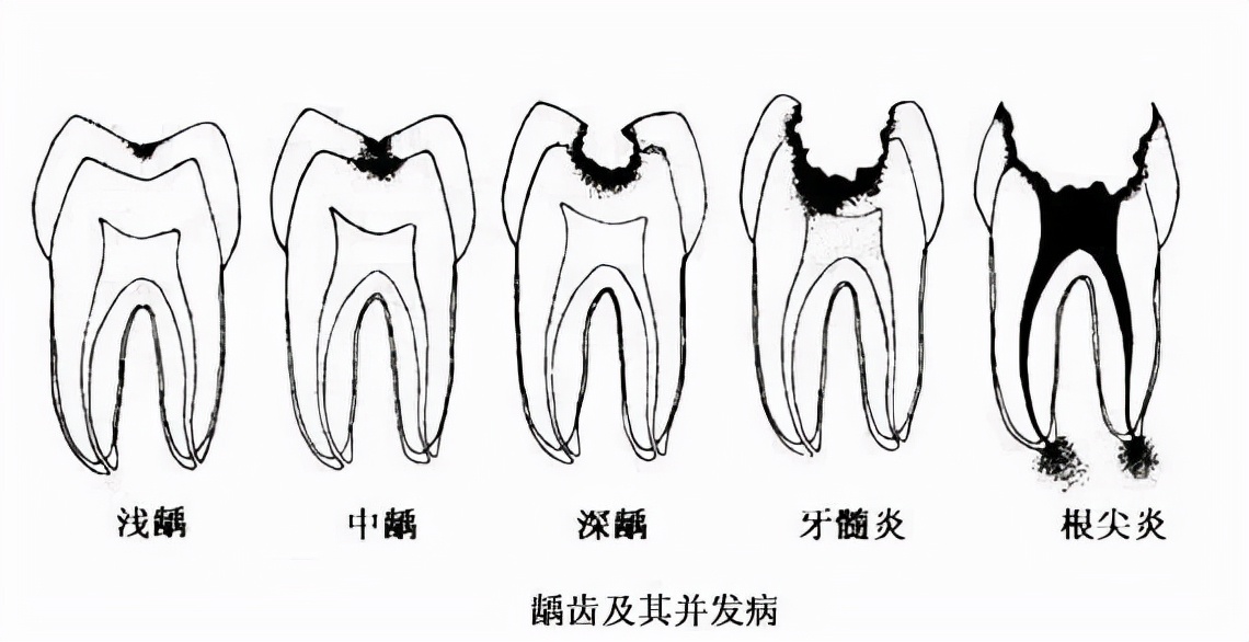 牙齿烂了一大半不补可以吗,牙齿全部烂了能不做牙冠吗