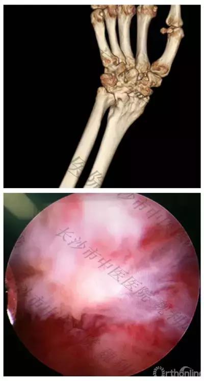 手腕囊肿抽吸出来后可否继续按压,足背囊肿穿刺好还是切除好