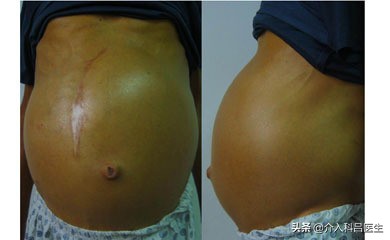 肝硬化腹水出血的后果,肝硬化导致腹水的主要原因是什么