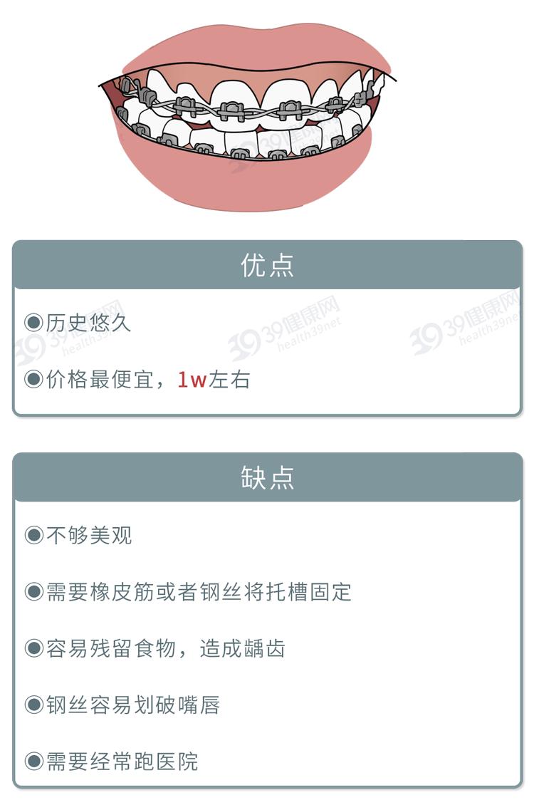 隐形牙套能矫正整齐吗,为什么戴牙套会让人变好看