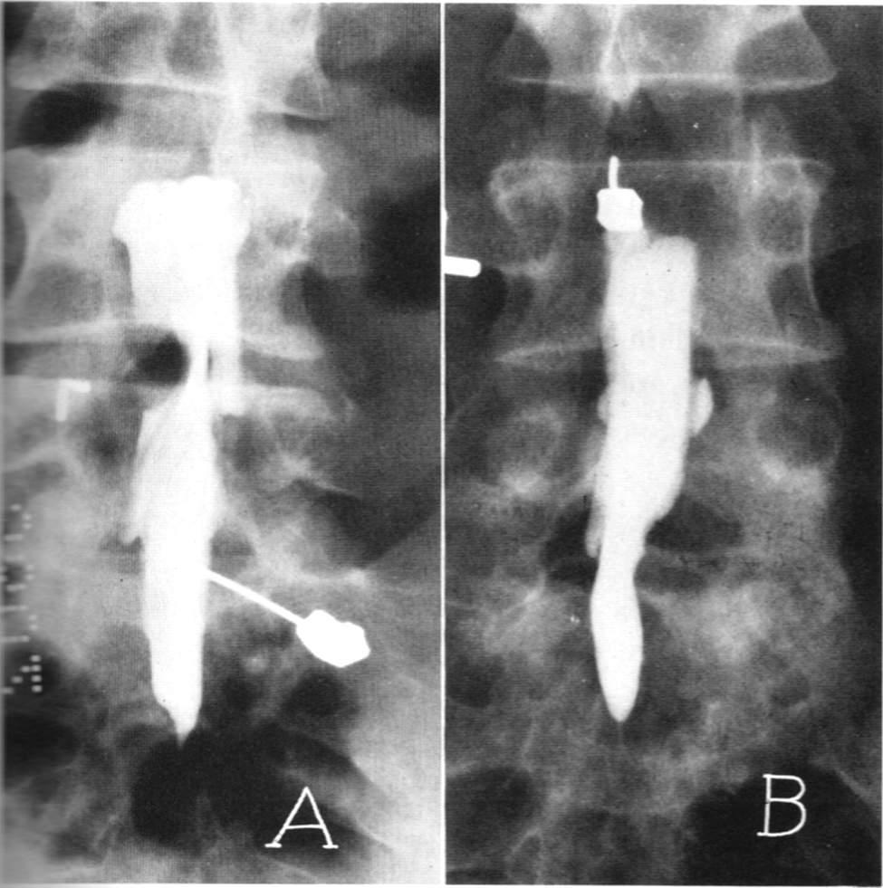腰椎间盘突出针灸有副作用吗,腰椎间盘突出针灸越来越严重